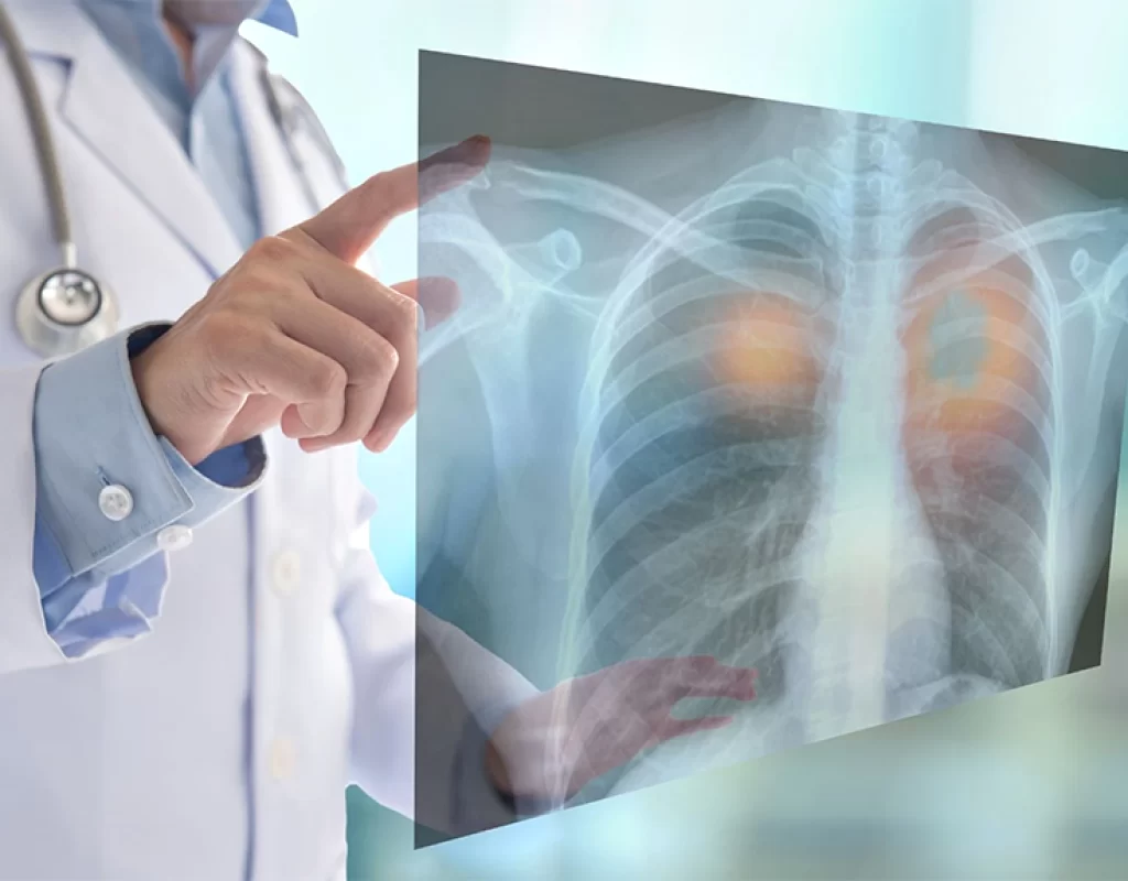 Pneumonia3