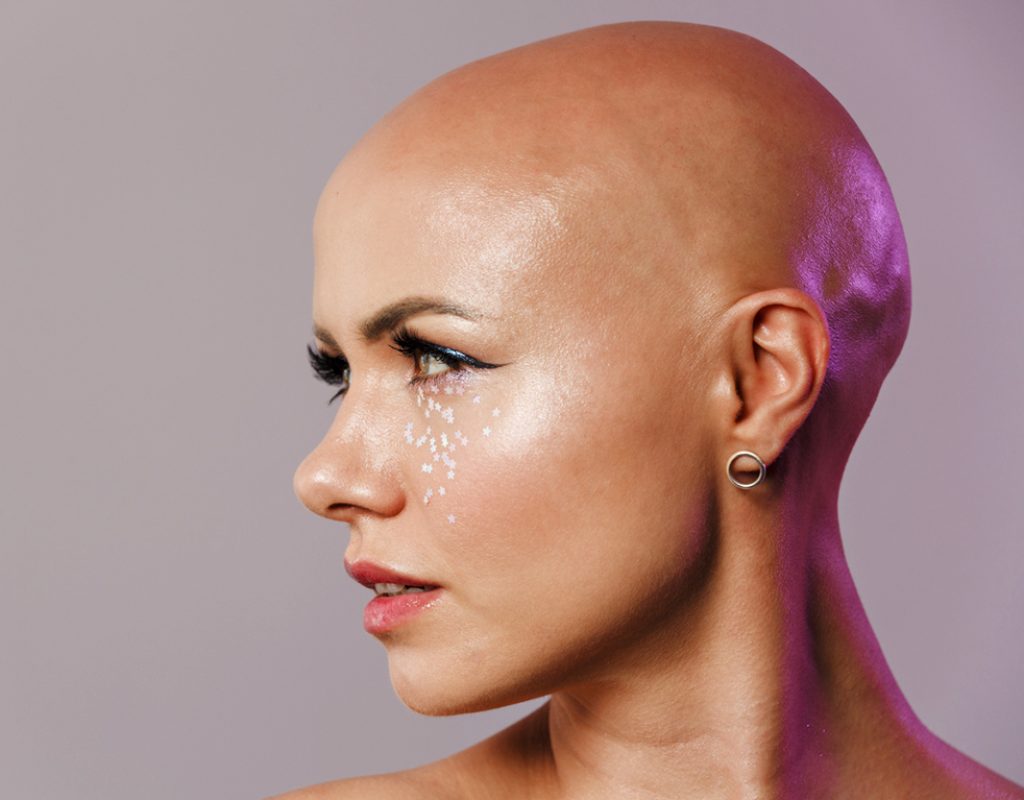 bonetti-alopecia-areata-why-does-it-occur