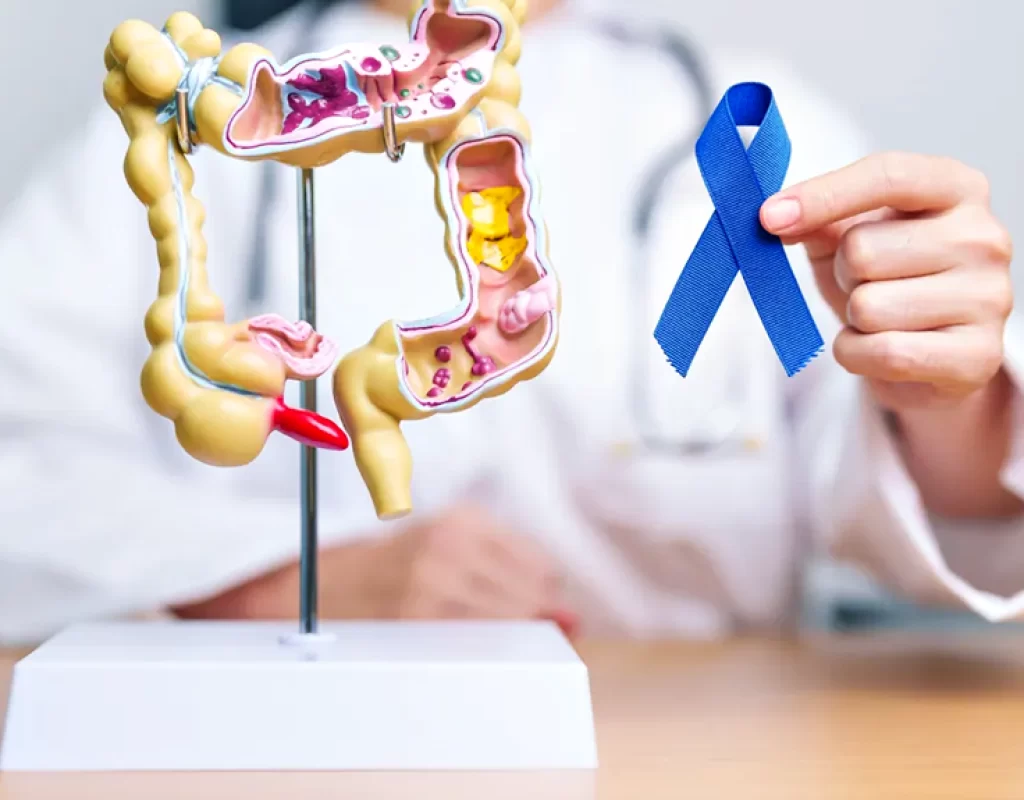 cancer-colorretal-intestino